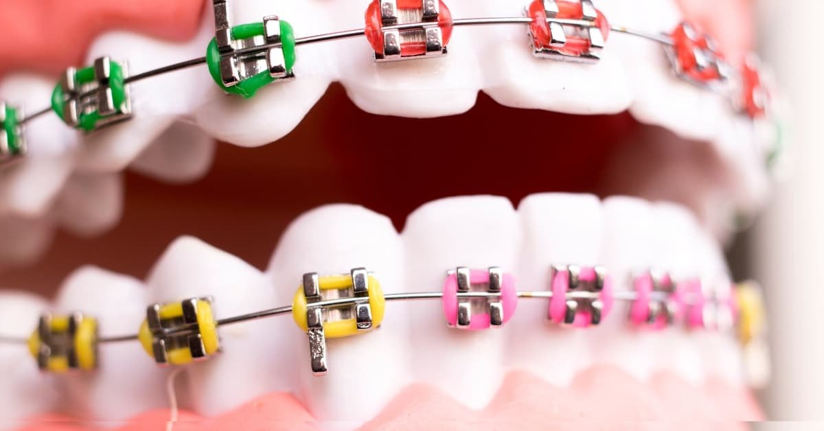 Color Braces