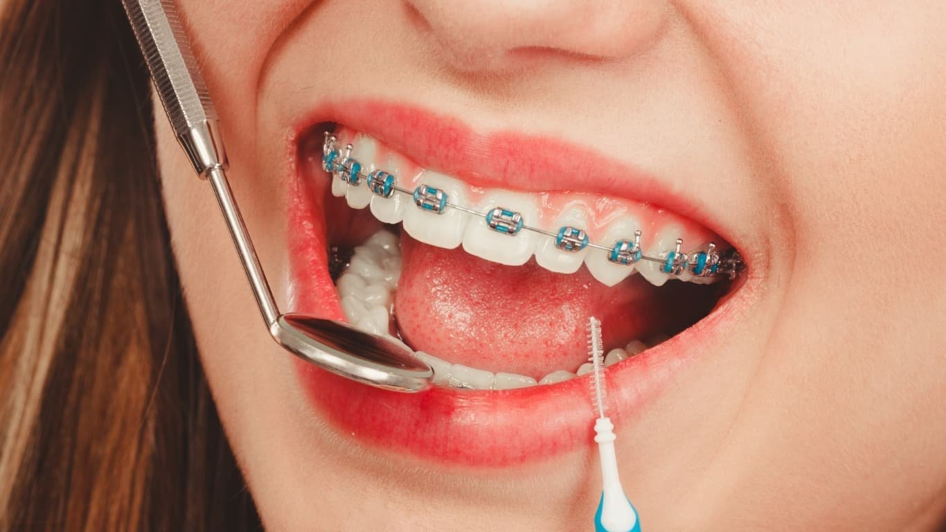 How Long Does It Take to Get Braces