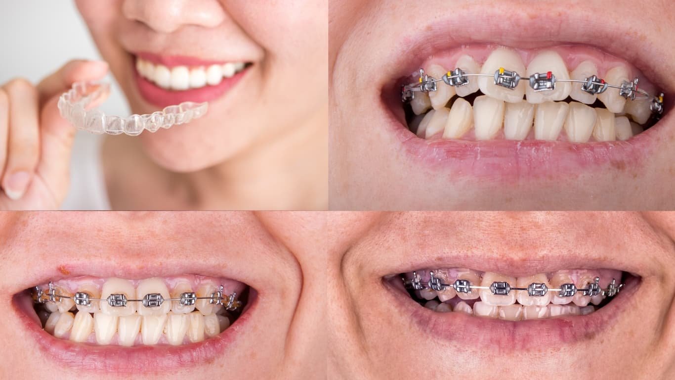 Types of Braces